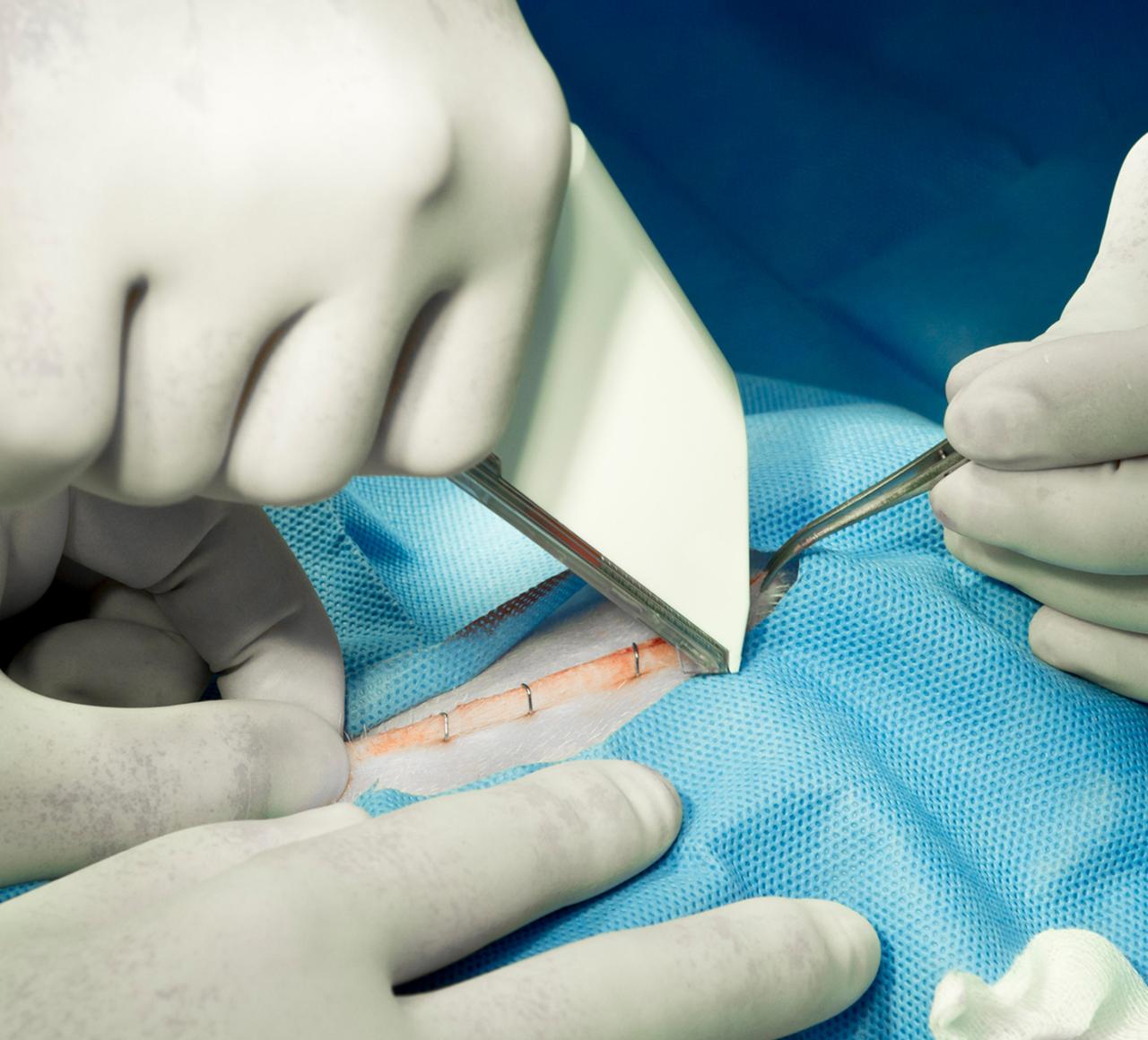 Surgical Staple Lawyers at Connie Cassano blog
